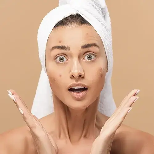 Zdjęcie Jak pozbyć się pryszczy domowe sposoby, które naprawdę działają