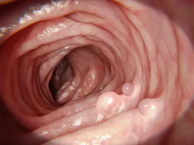 Zdjęcie Ból esicy objawy: Jak rozpoznać niebezpieczne symptomy?