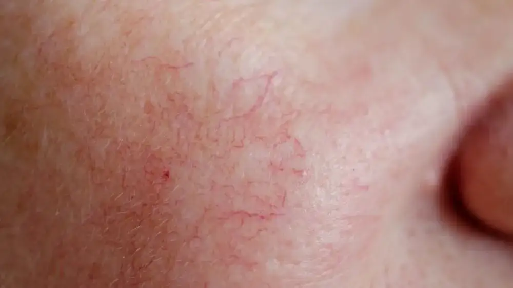 Zdjęcie Cera naczynkowa: Skuteczne metody leczenia i pielęgnacji | Przewodnik