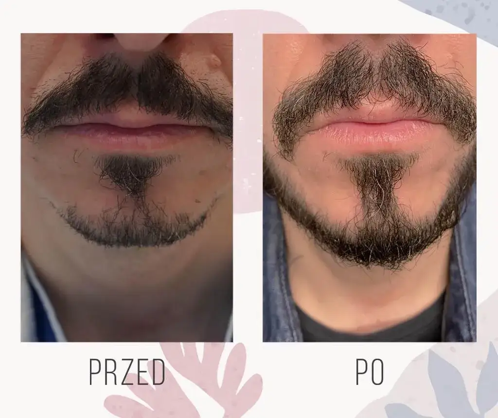 Zdjęcie Jak zapuścić brodę przy słabym zaroście i cieszyć się gęstym zarostem