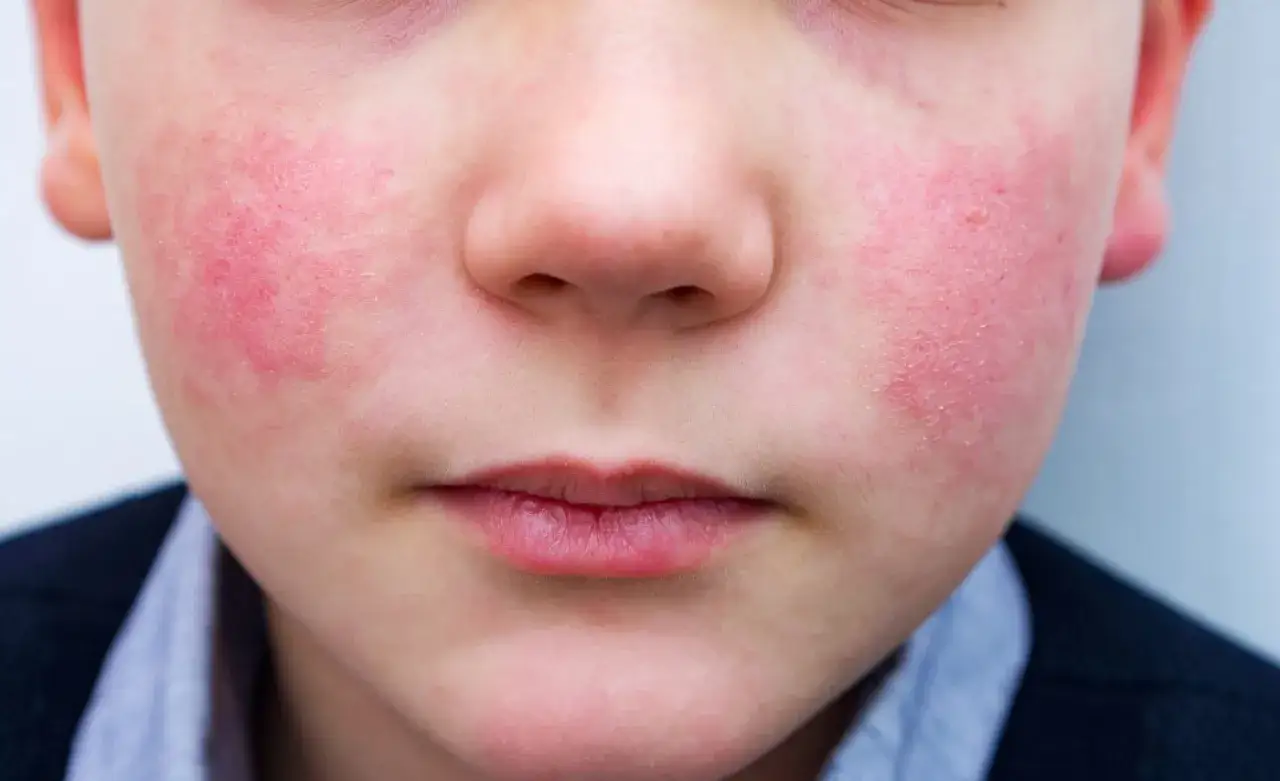 Zdjęcie Toczeń: Jak rozpoznać 5 niebezpiecznych zmian skórnych? Pomagamy