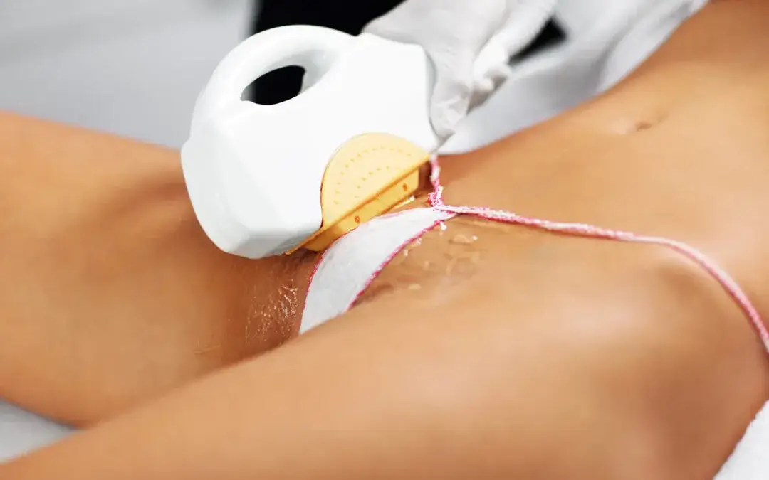 Zdjęcie Co obejmuje bikini brazylijskie? Szczegóły depilacji intymnej