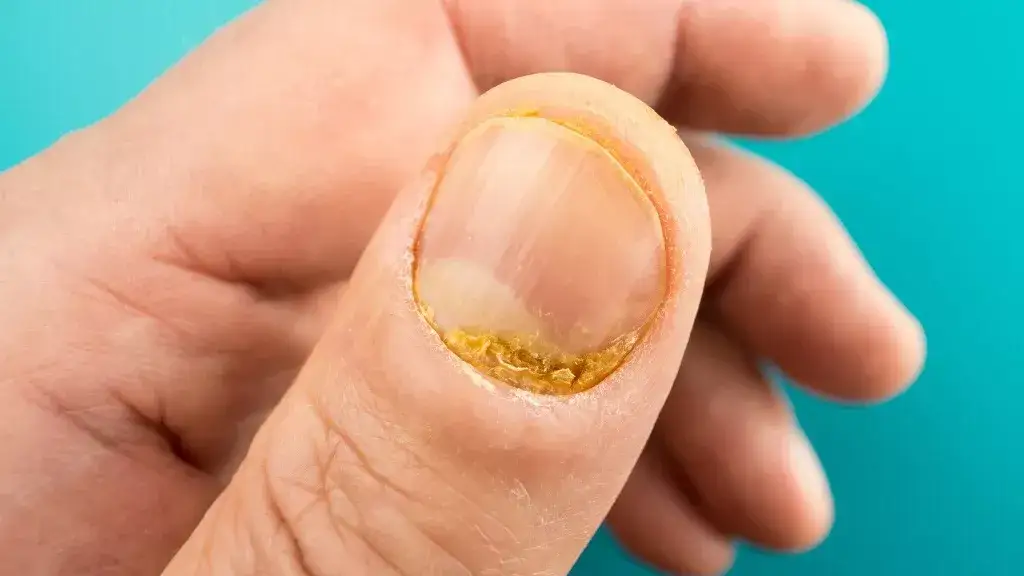 Zdjęcie Uszkodzona macierz paznokcia: jak leczyć? Domowe i profesjonalne metody