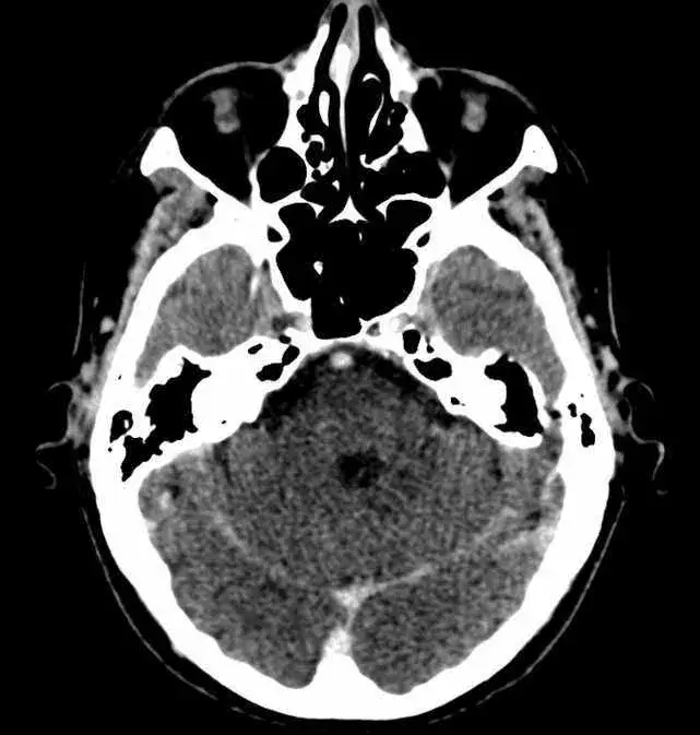 Zdjęcie Zatoka klinowa gdzie jest? Odkryj jej tajemnice w anatomicznej budowie