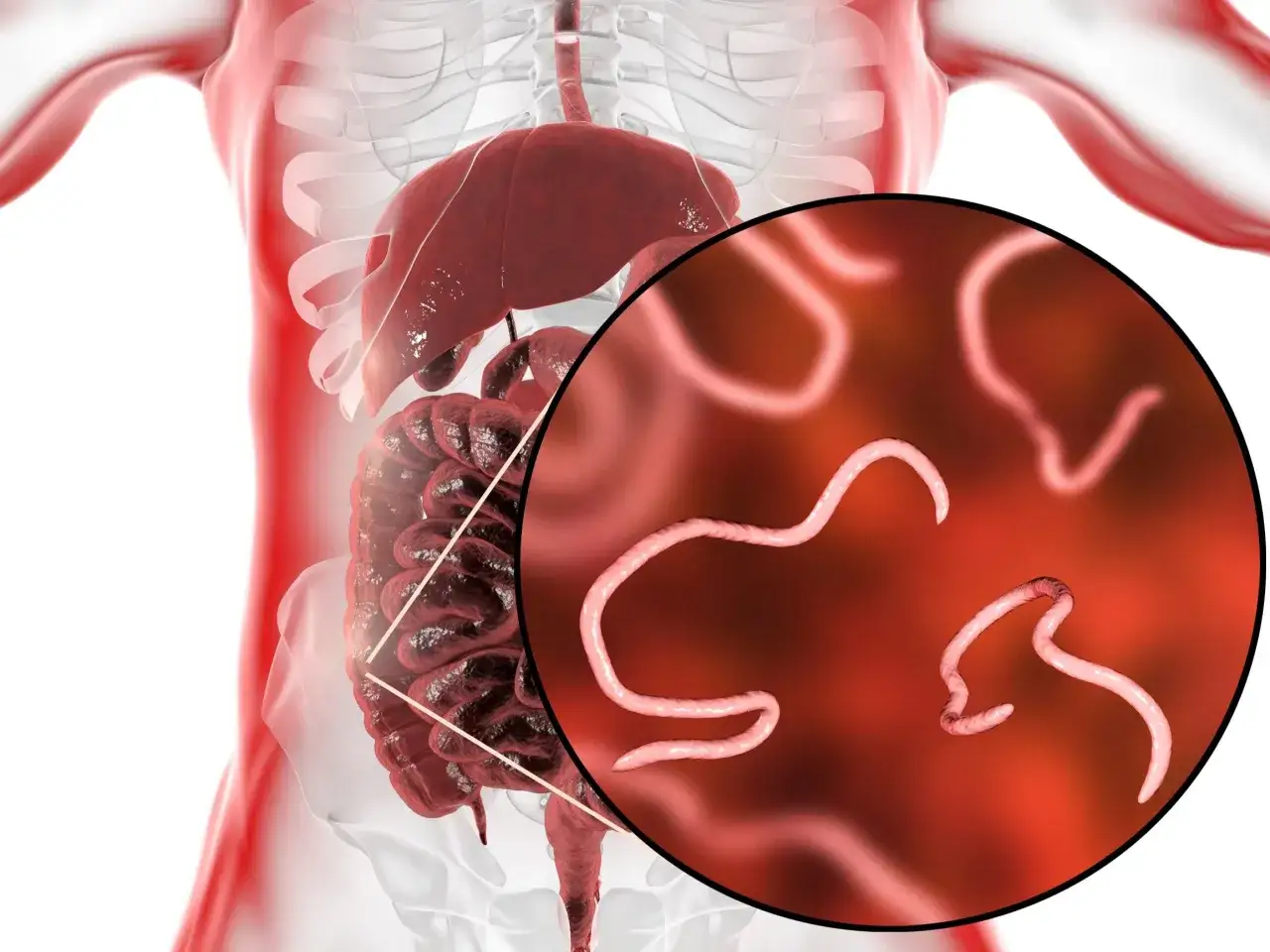 Zdjęcie Owsiki u dzieci: Czy to przyczyna bólu brzucha? Wyjaśniamy