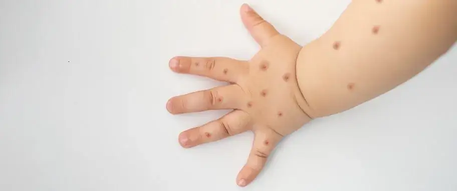 Zdjęcie Jak zapobiec bostonce u dzieci i uniknąć zakażeń w rodzinie