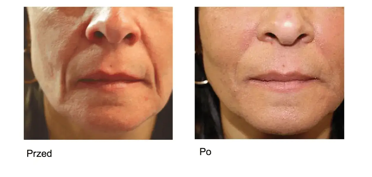 Zdjęcie Kwas hialuronowy doustnie czy działa? Sprawdź jego realne efekty