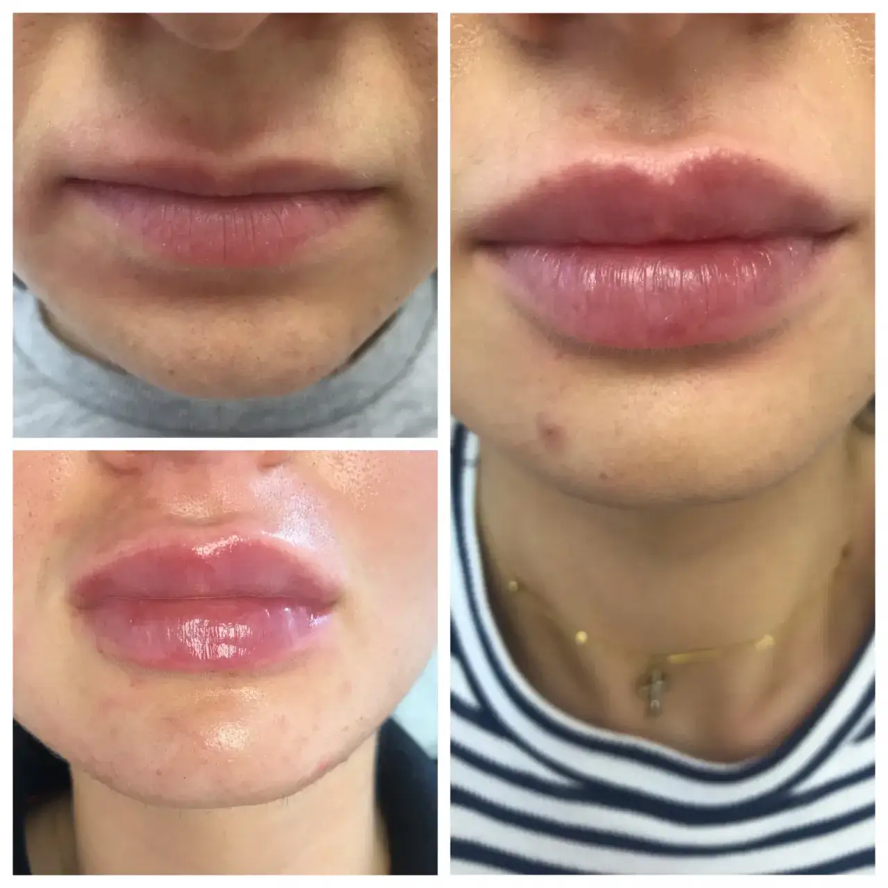 Zdjęcie Czy można się całować po powiększaniu ust? Oto co musisz wiedzieć