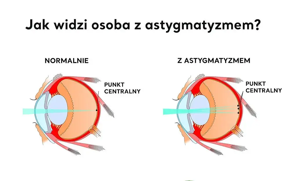 Zdjęcie Czym jest cylinder w wadzie wzroku i jak wpływa na astygmatyzm? Wyjaśniamy prosto!