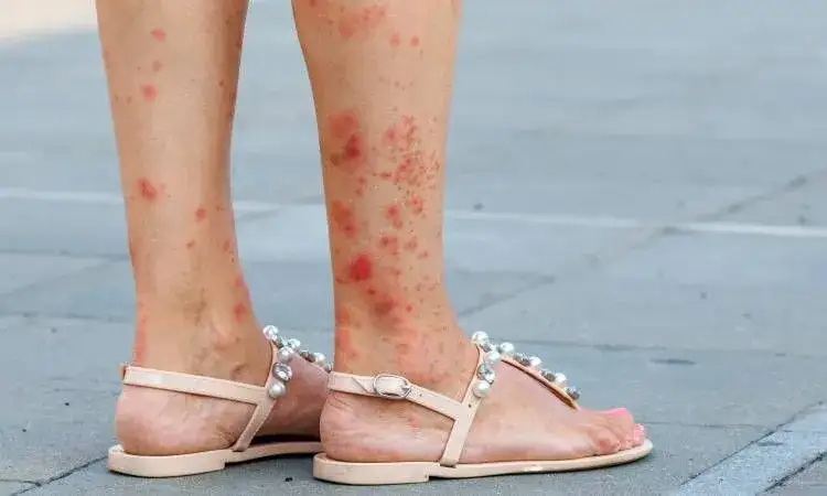 Zdjęcie Pryszcze na nogach od czego? Odkryj przyczyny i skuteczne rozwiązania