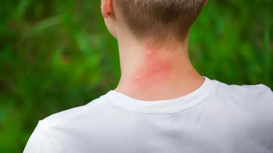 Zdjęcie Wysypka jak ugryzienie komara u dziecka? Pokrzywka, alergia, Skeeter