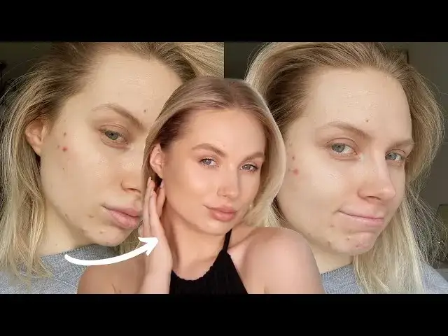 Zdjęcie Jak zakryć pryszcze? Kompleksowy poradnik makijażowy i bezmakijażowy