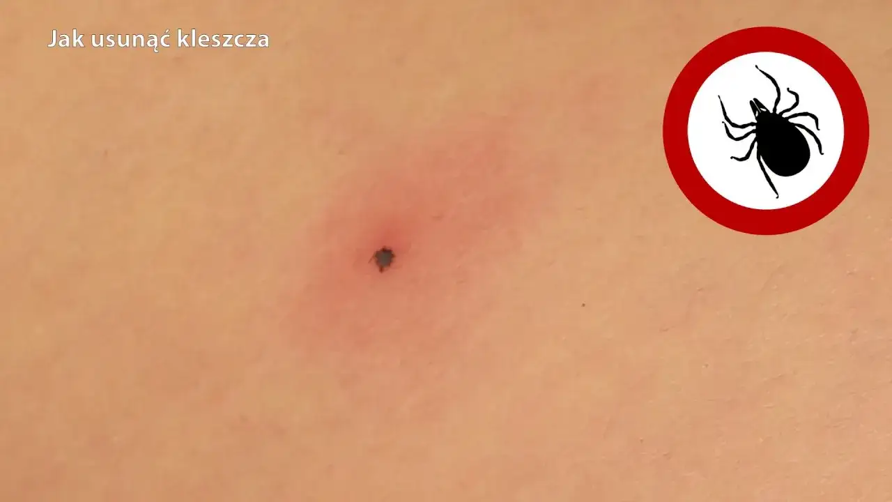 Zdjęcie Jak wyciągnąć kleszcza dziecku bez ryzyka i komplikacji