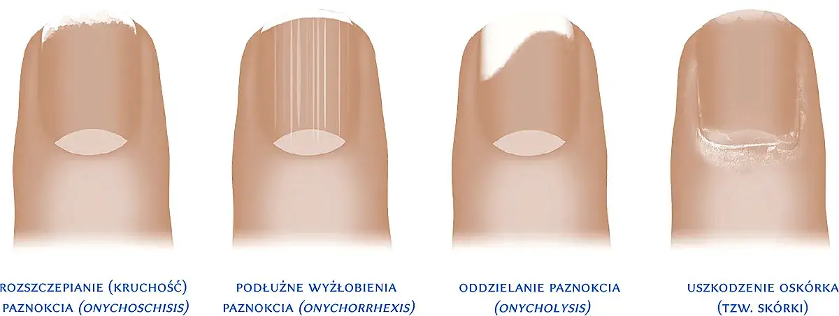 Zdjęcie Skuteczne metody na onycholizę paznokci – co na onycholizę paznokci?
