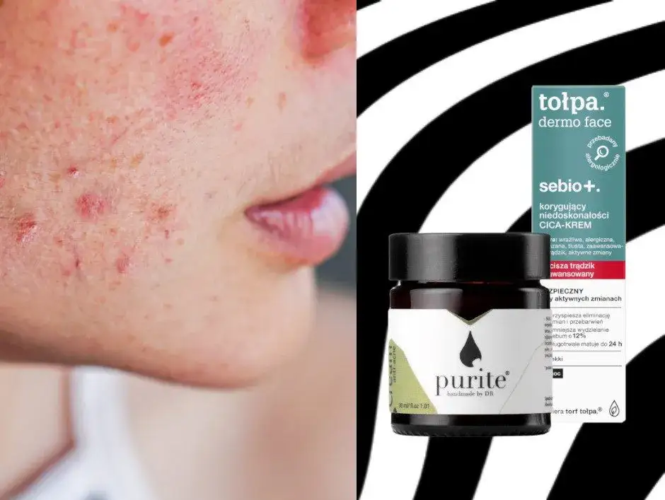 Zdjęcie Tołpa Estetic Trądzik: Czy ten krem na trądzik naprawdę działa?