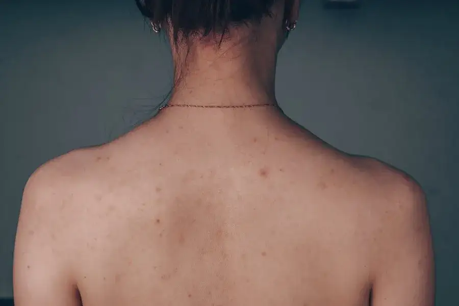 Zdjęcie Pryszcze na plecach: Jak się ich pozbyć? Kompleksowy poradnik