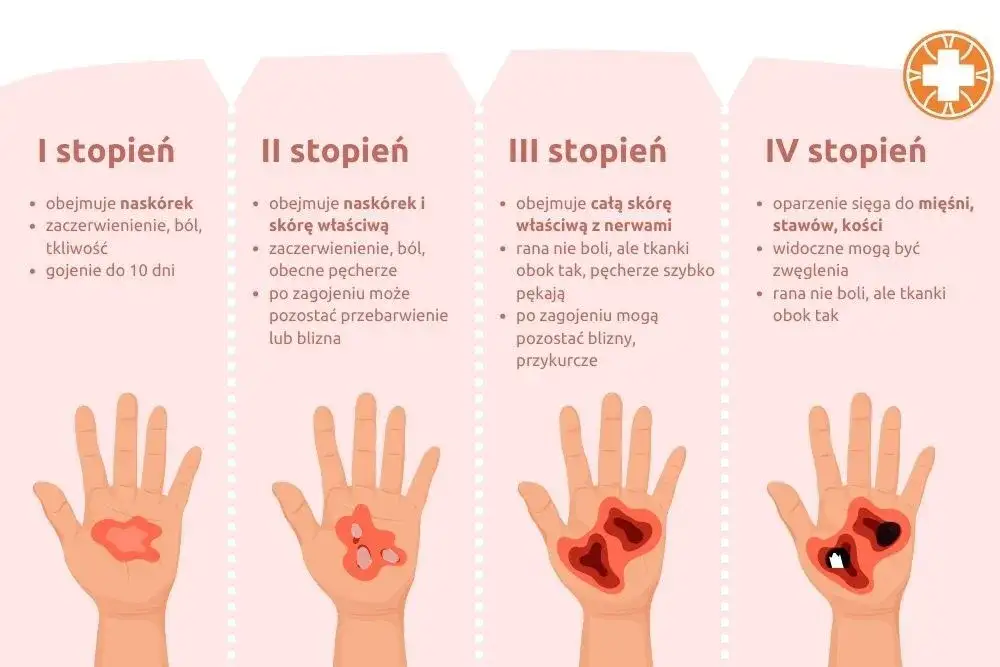 Zdjęcie Skuteczne sposoby na oparzenia słoneczne u dziecka – jak pomóc?