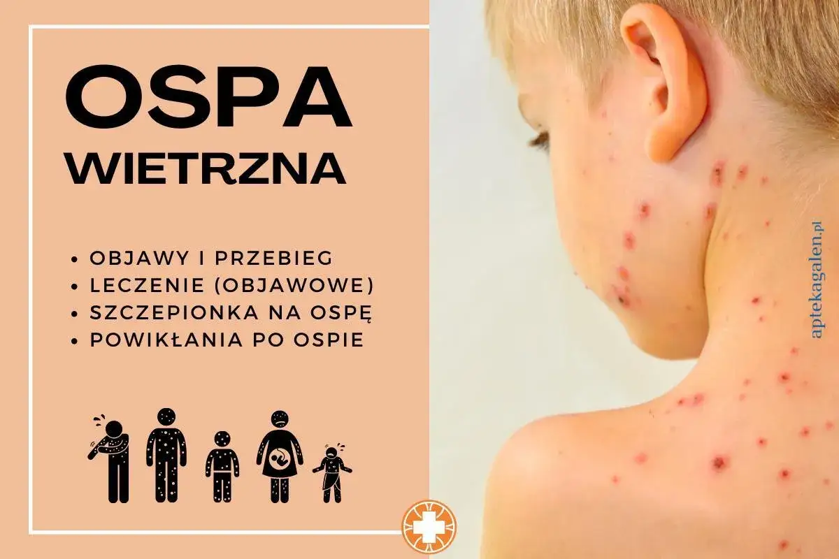 Zdjęcie Jak bezpiecznie kąpać dziecko z ospą, aby złagodzić objawy i swędzenie