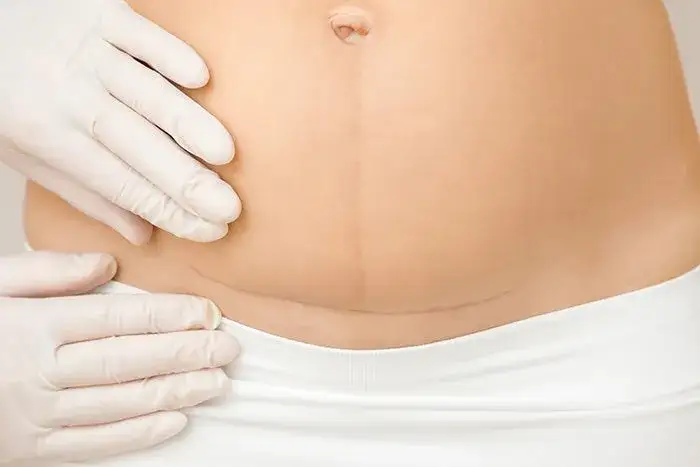 Zdjęcie Kiedy do fizjoterapeuty po cc? Kluczowe wskazówki dla mam po cesarce