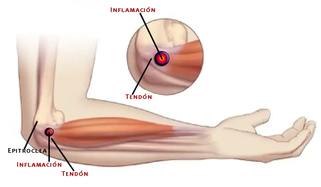 Zdjęcie Edema muscular pronador redondo: ¿Por qué duele tu antebrazo?