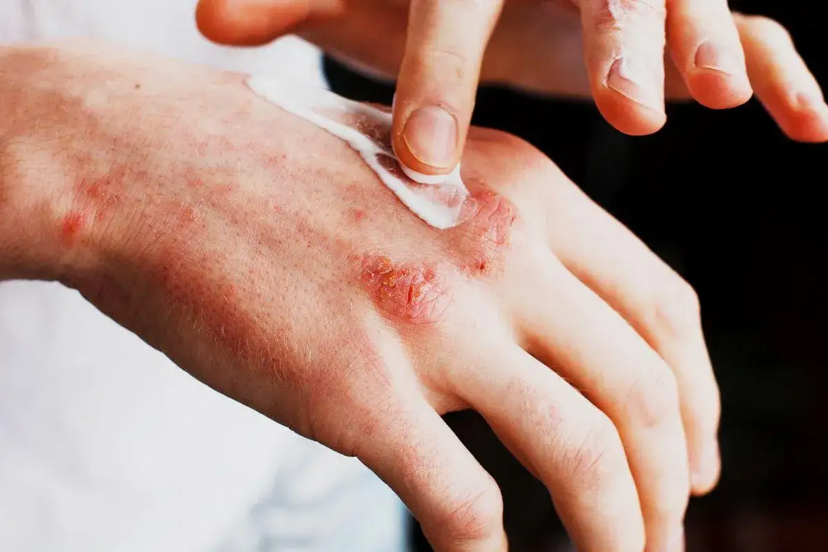Zdjęcie Alergia na mleko u dorosłych: objawy skórne, diagnoza i leczenie