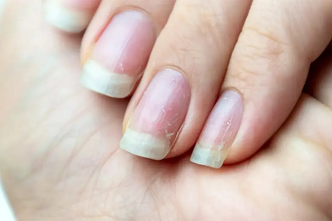 Zdjęcie C&oacute;mo endurecer las u&ntilde;as d&eacute;biles con remedios naturales efectivos