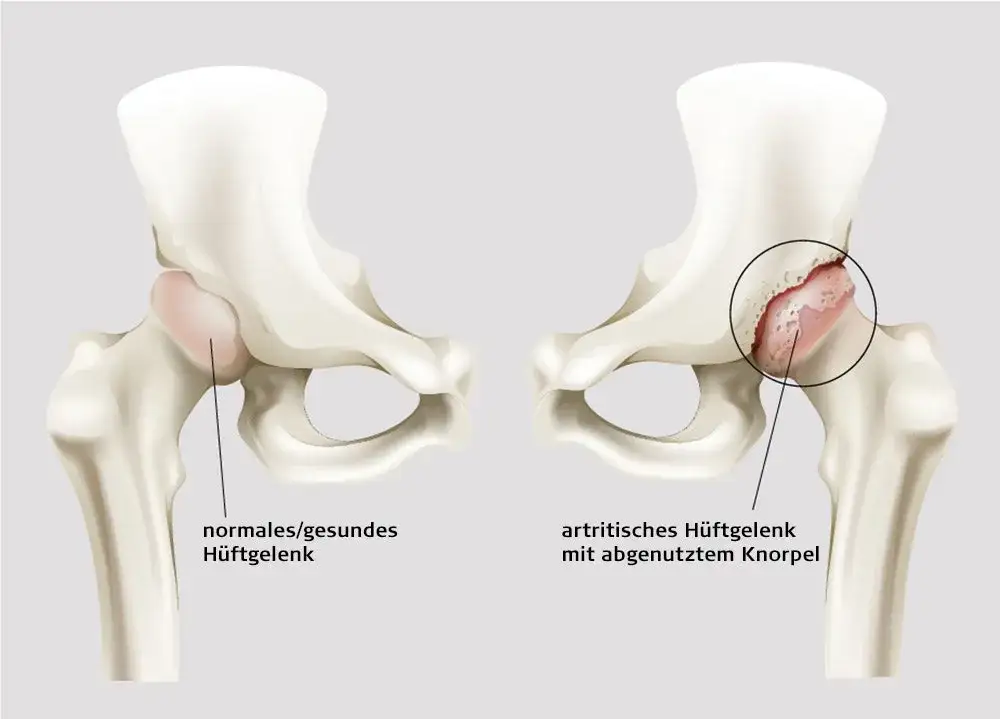 Zdjęcie Coxarthrose Symptome: So erkennen Sie die schmerzhaften Anzeichen
