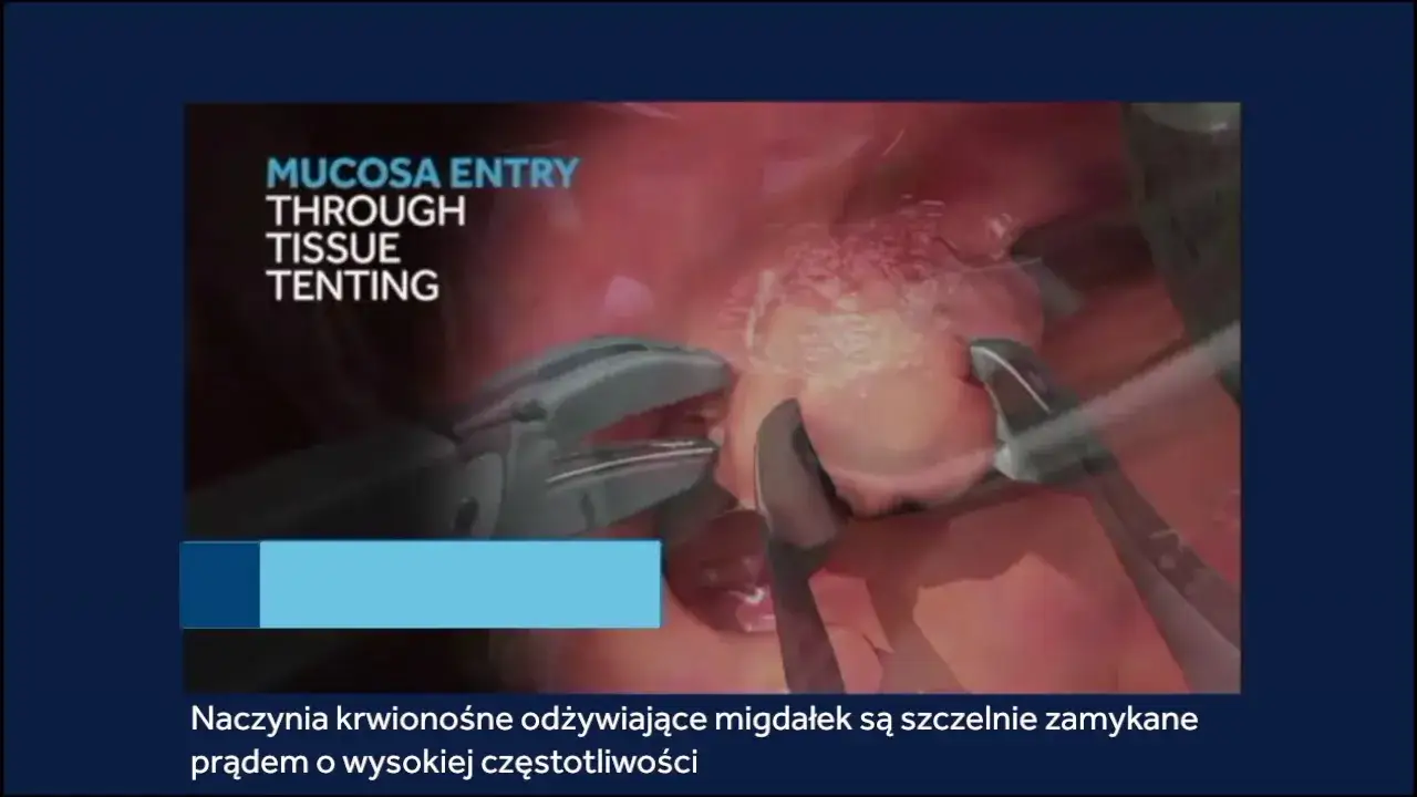 Zdjęcie Gdzie najszybciej wyciąć migdałki NFZ i uniknąć długiego czekania