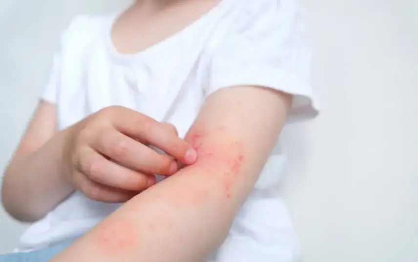 Zdjęcie Alergia sk&oacute;rna: objawy, przyczyny i skuteczne sposoby leczenia