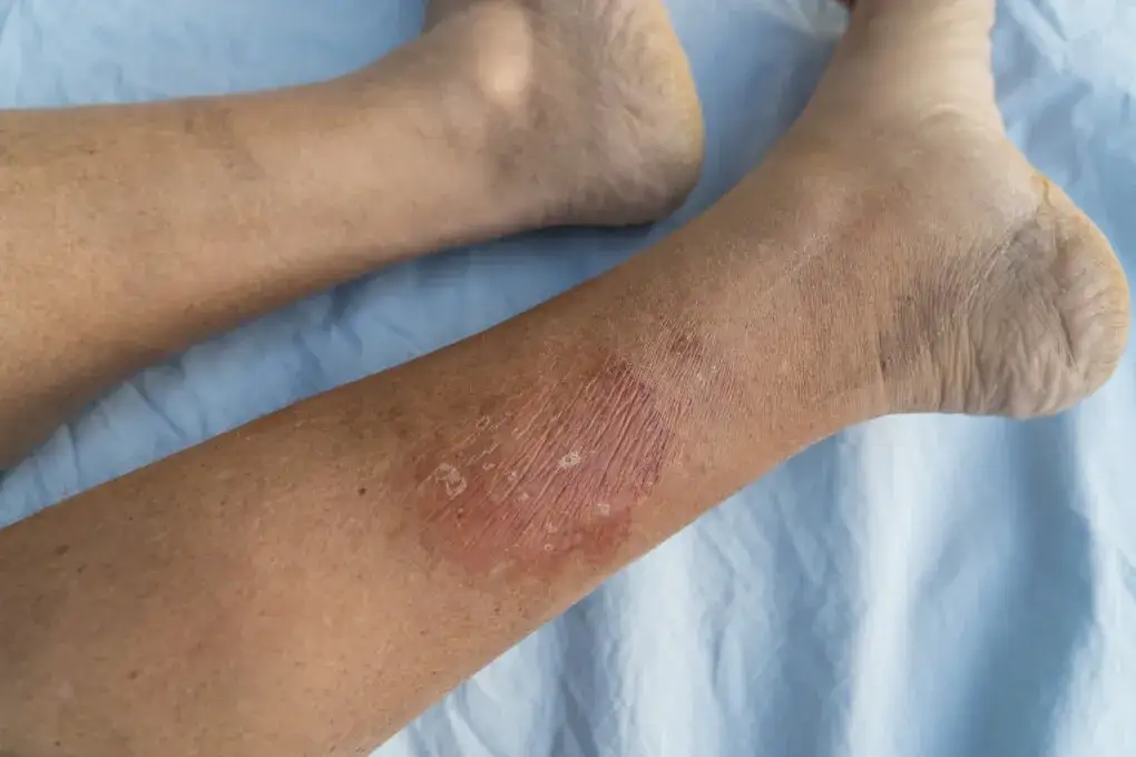 Zdjęcie Choroba róża na nodze objawy – jak rozpoznać i uniknąć powikłań