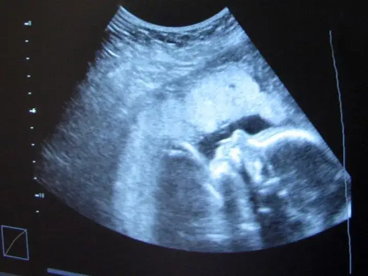 Zdjęcie Czy przed badaniami prenatalnymi można jeść? Sprawdź, co musisz wiedzieć!