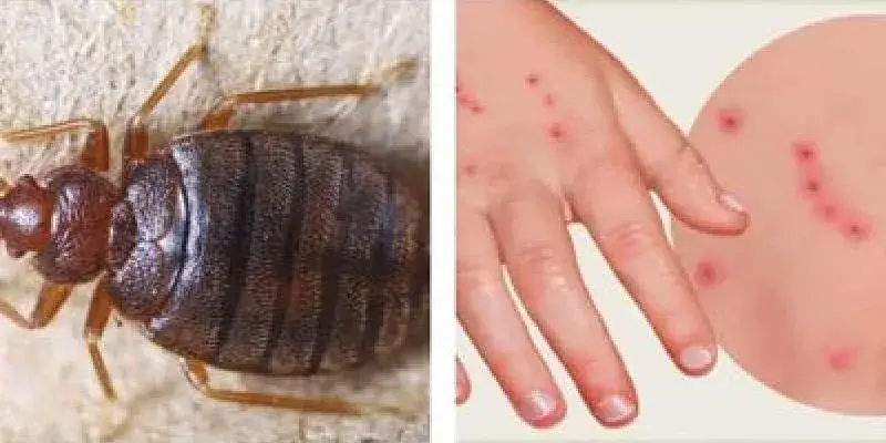 Zdjęcie Cómo evitar las picaduras de pulgas en humanos y sus efectos dañinos