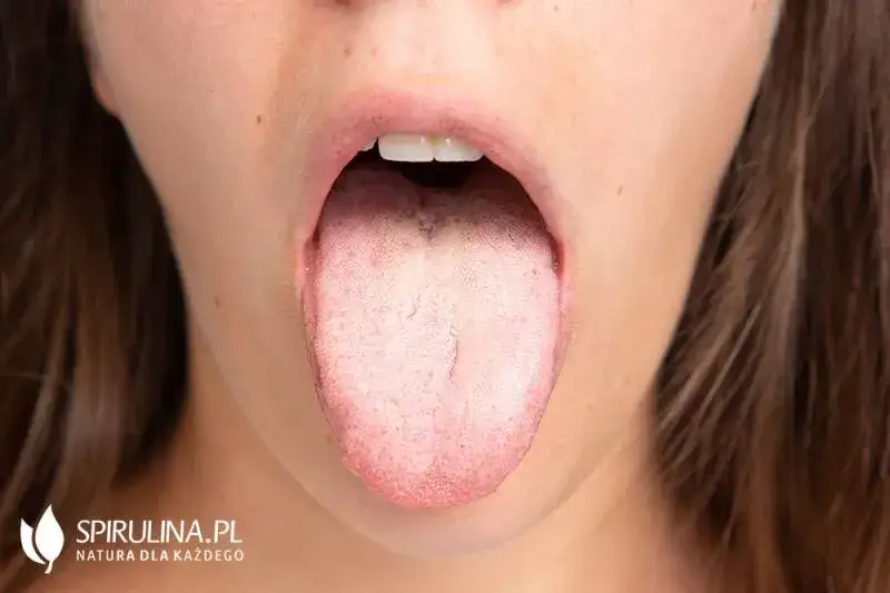 Zdjęcie Skuteczne sposoby na pryszcz na języku – jak się pozbyć bólu i dyskomfortu