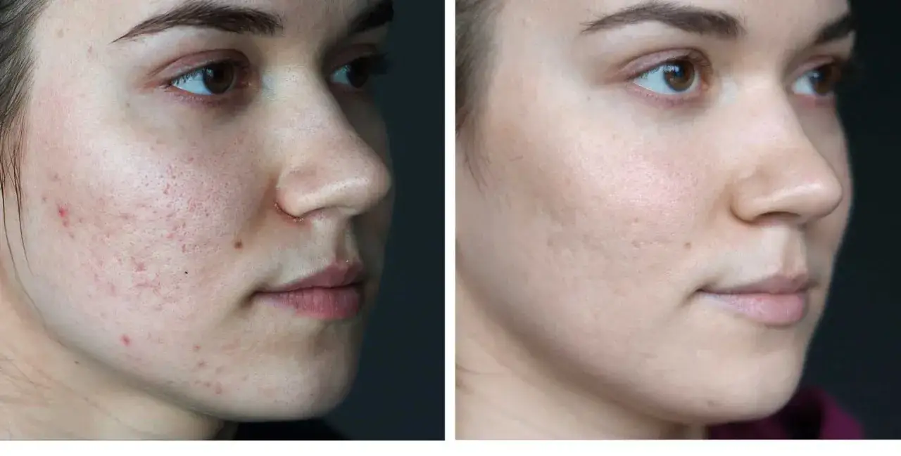 Zdjęcie Laserowe wygładzanie zmarszczek - skuteczna metoda odmładzania skóry