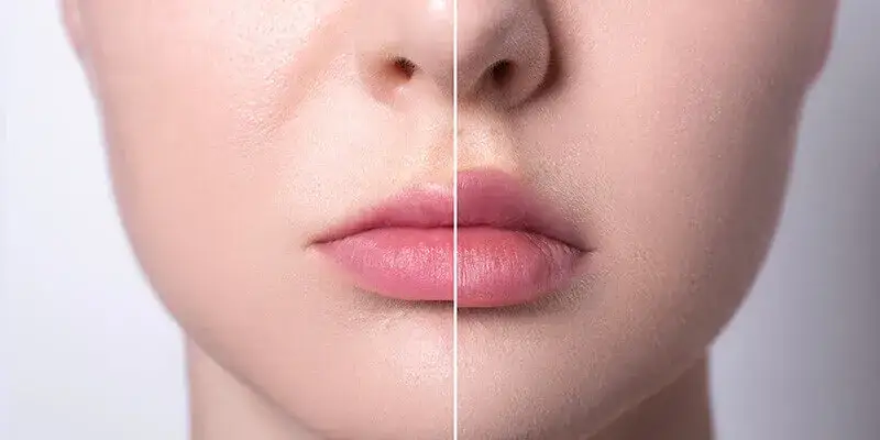 Zdjęcie Ile kosztuje powiększanie ust kwasem hialuronowym? Ceny w Polsce