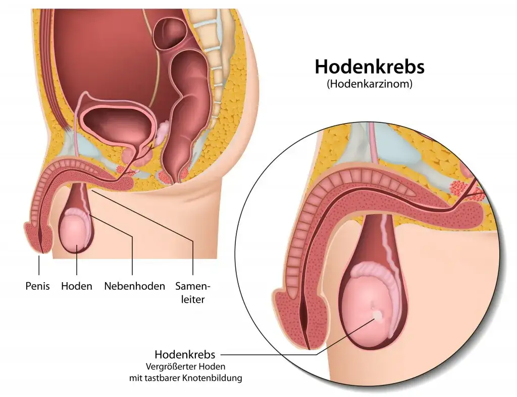 Zdjęcie Hodenkrebs Vorsorge: So schützen Sie sich effektiv vor Krebsrisiken