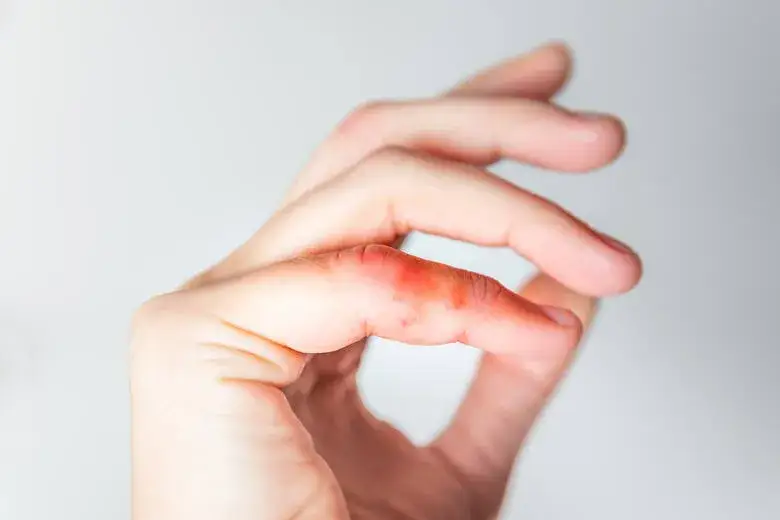 Zdjęcie Odmrożenie gazem LPG co robić: unikaj tych błędów w leczeniu