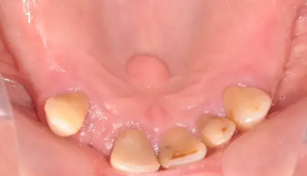 Zdjęcie Objawy włókniaka jamy ustnej – jak rozpoznać i czy to groźne?