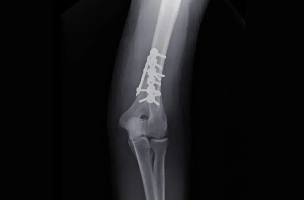 Zdjęcie Jak długo trwa rehabilitacja po złamaniu kości ramiennej? Oczekuj więcej!