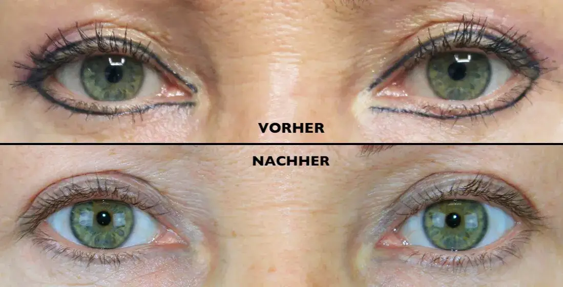 Zdjęcie PMU entfernen: Was Sie &uuml;ber Laser, Remover &amp; Kosten wissen m&uuml;ssen
