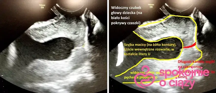 Zdjęcie Jak zmienia się szyjka macicy przed porodem? Kluczowe objawy i porady