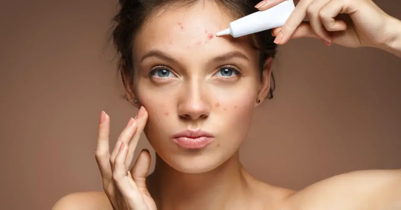 Zdjęcie Dlaczego pryszcze wyskakują w tym samym miejscu? Sprawdź przyczyny