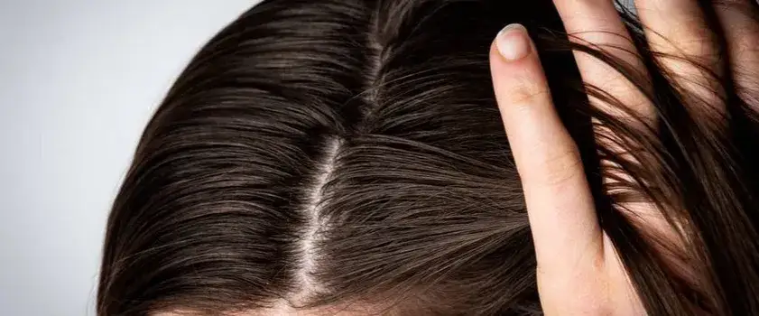 Zdjęcie Dlaczego włosy szybko się przetłuszczają i wypadają? Poznaj skuteczne metody