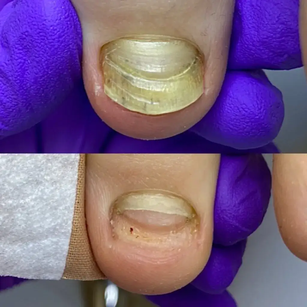 Zdjęcie Jak długo boli zbity paznokieć? Czas gojenia i ulga w bólu