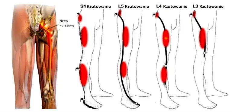 Zdjęcie Rwa kulszowa a ból kolana: objawy, które musisz znać