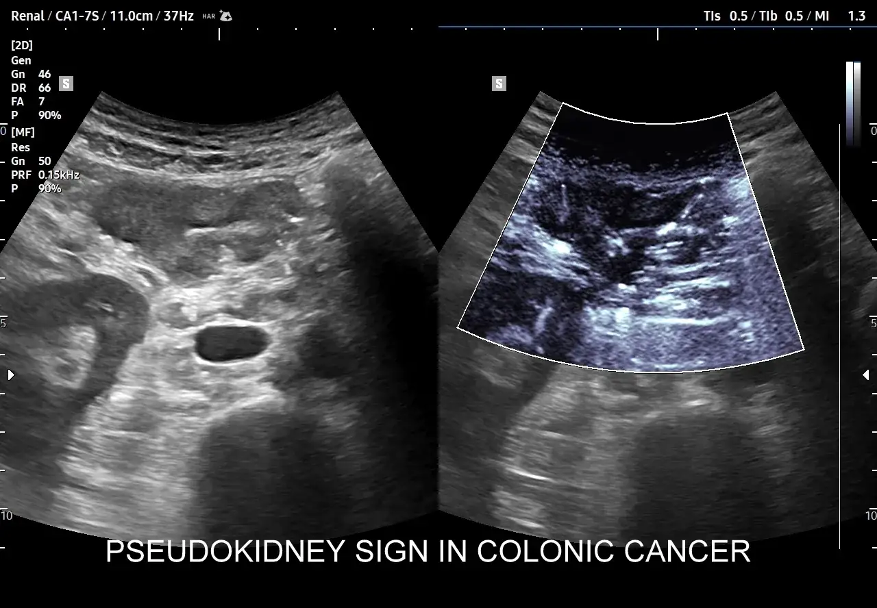 Zdjęcie Czy USG wykryje raka jelita grubego? Odkryj ograniczenia tej metody