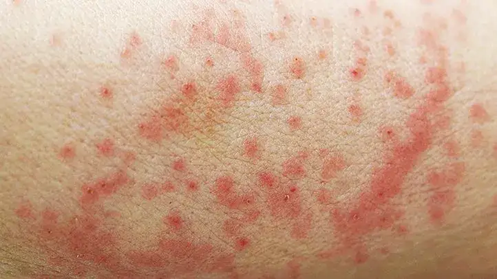 Zdjęcie Skuteczne sposoby na pryszcze na pupie – jak się ich pozbyć?