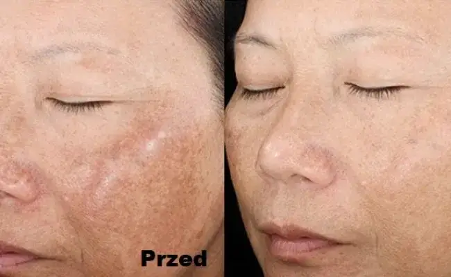 Zdjęcie Peeling kawitacyjny czy warto? Odkryj efekty i zalety zabiegu