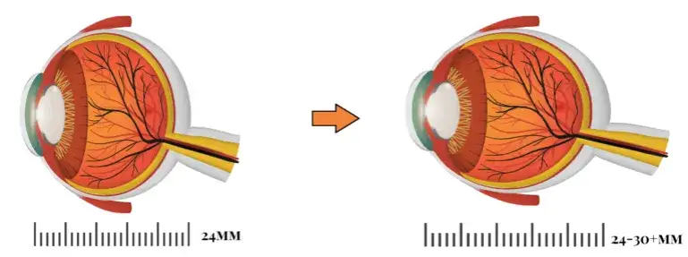 Zdjęcie Jak wyleczyć krótkowzroczność i poprawić jakość widzenia?
