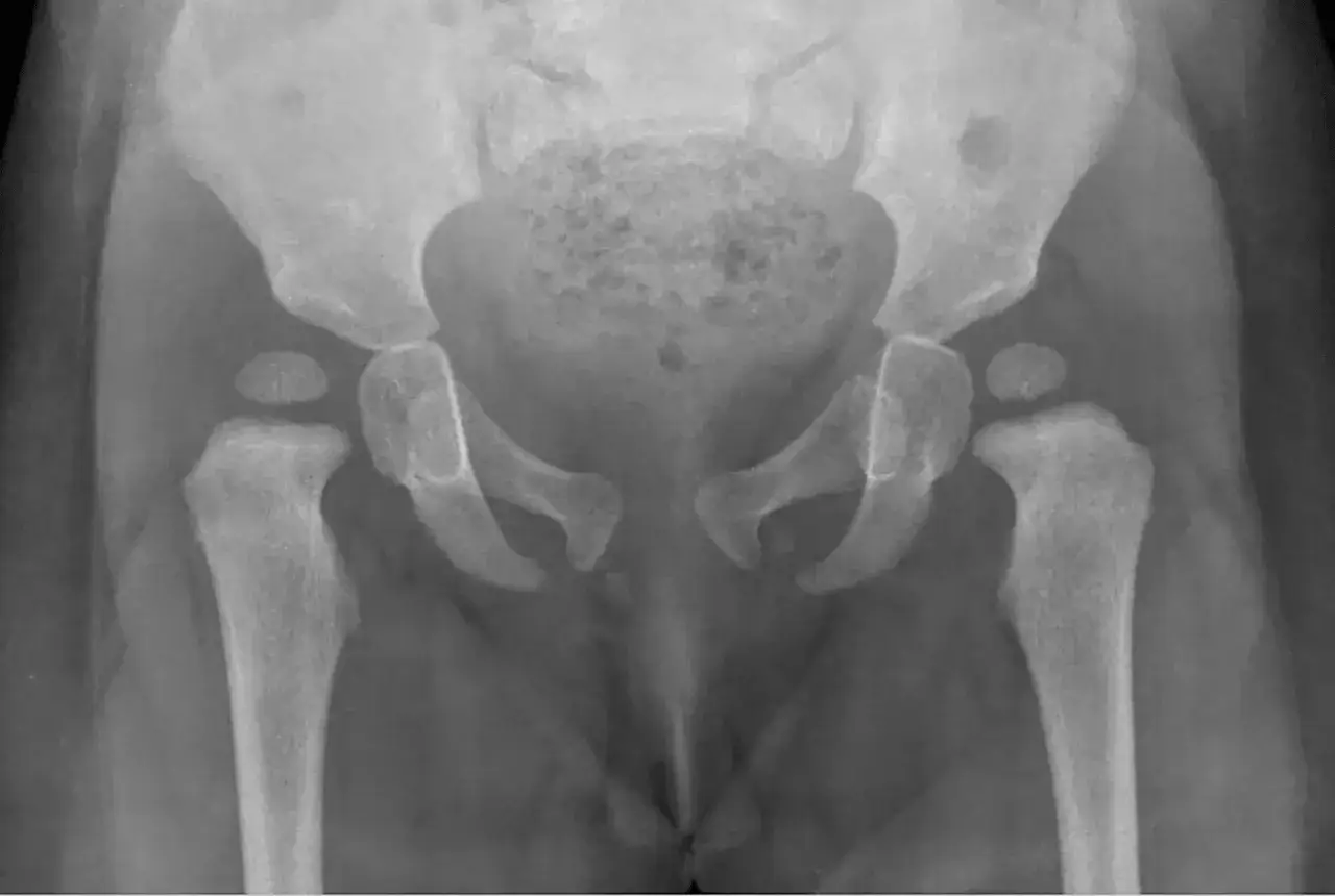 Zdjęcie Problemy z bioderkami u niemowlaka: 7 kluczowych objawów